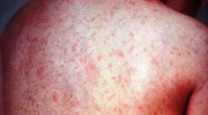 Rujeola încă face ravagii în România anului 2018